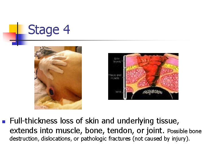 Stage 4 n Full-thickness loss of skin and underlying tissue, extends into muscle, bone,