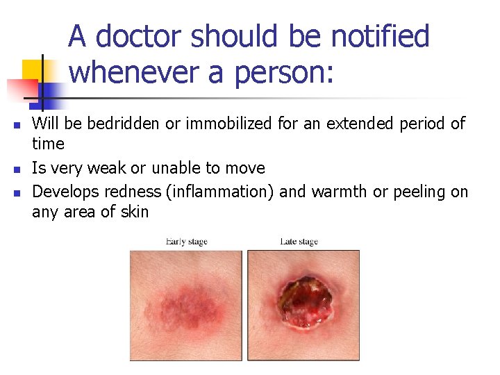 A doctor should be notified whenever a person: n n n Will be bedridden