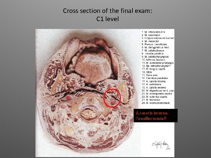 Cross section of the final exam: C 1 level A. carotis interna. Tonsillectomia!! 