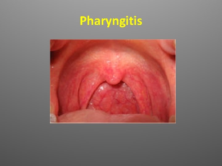 Pharyngitis <> 