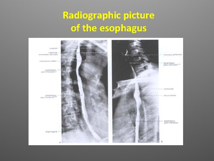 Radiographic picture of the esophagus 