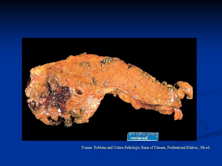 Kumar: Robbins and Cotran Pathologic Basis of Disease, Professional Edition , 8 th ed.