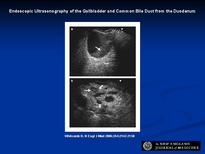 Endoscopic Ultrasonography of the Gallbladder and Common Bile Duct from the Duodenum Whitcomb D.