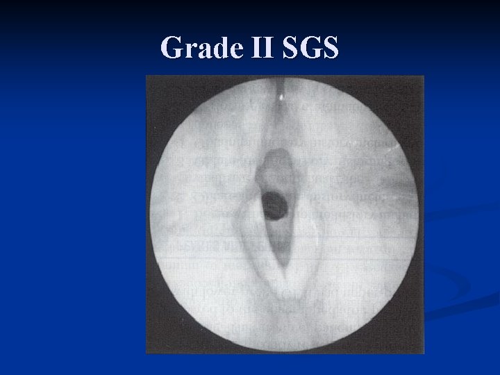 Grade II SGS 