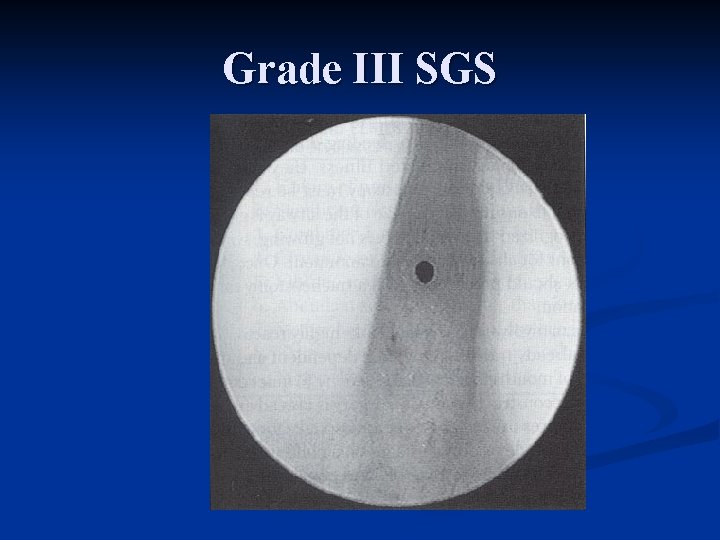 Grade III SGS 