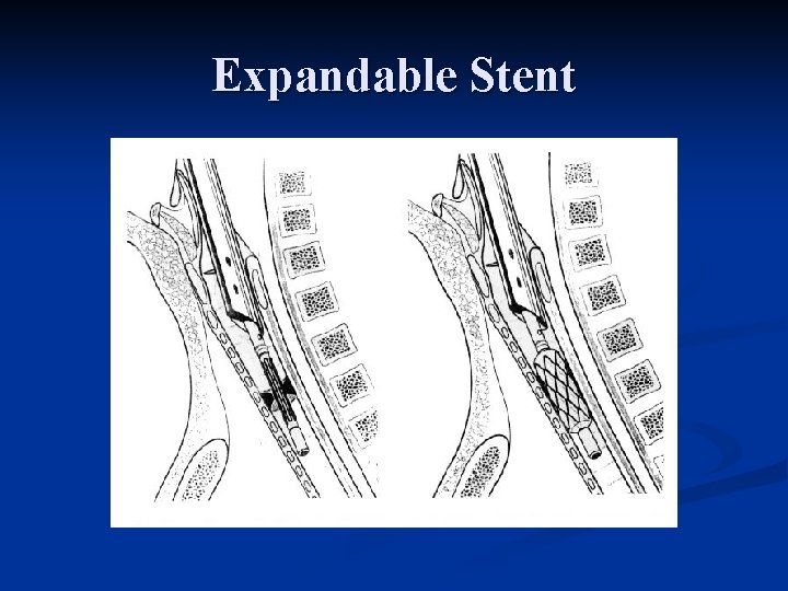 Expandable Stent 