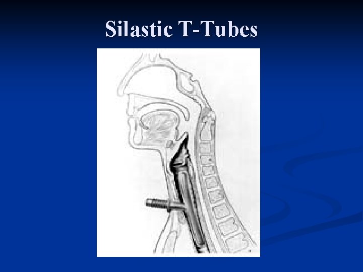 Silastic T-Tubes 