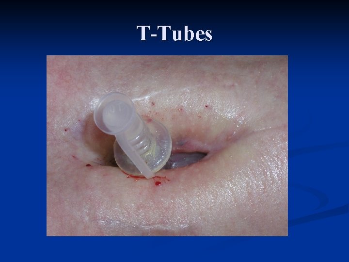 T-Tubes 