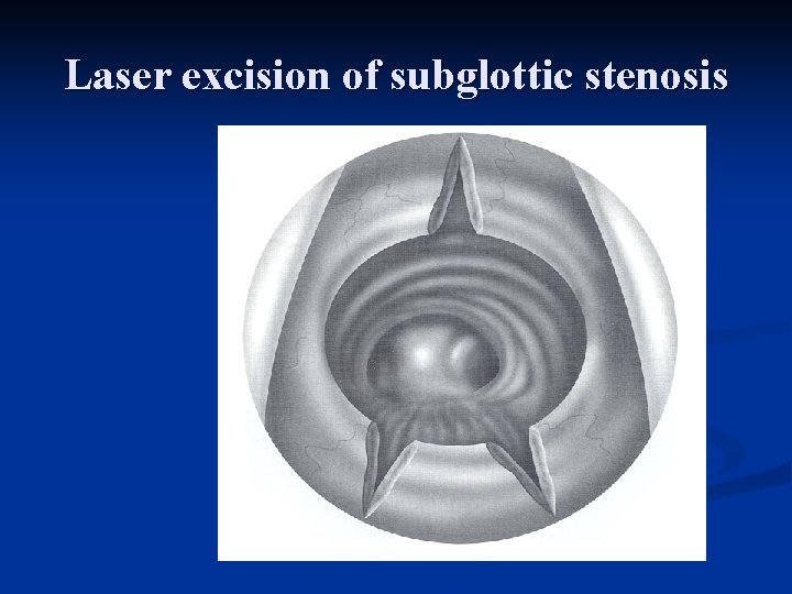 Laser excision of subglottic stenosis 