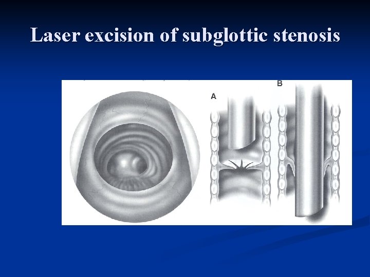 Laser excision of subglottic stenosis 