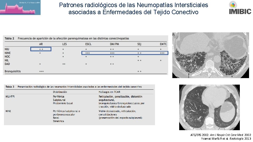 Patrones radiológicos de las Neumopatías Intersticiales asociadas a Enfermedades del Tejido Conectivo ATS/ERS 2002.