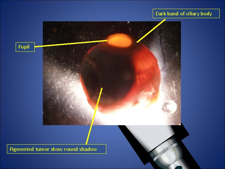 Dark band of ciliary body Pupil Pigmented tumor show round shadow Dark band of ciliary body Pupil Pigmented tumor show round shadow