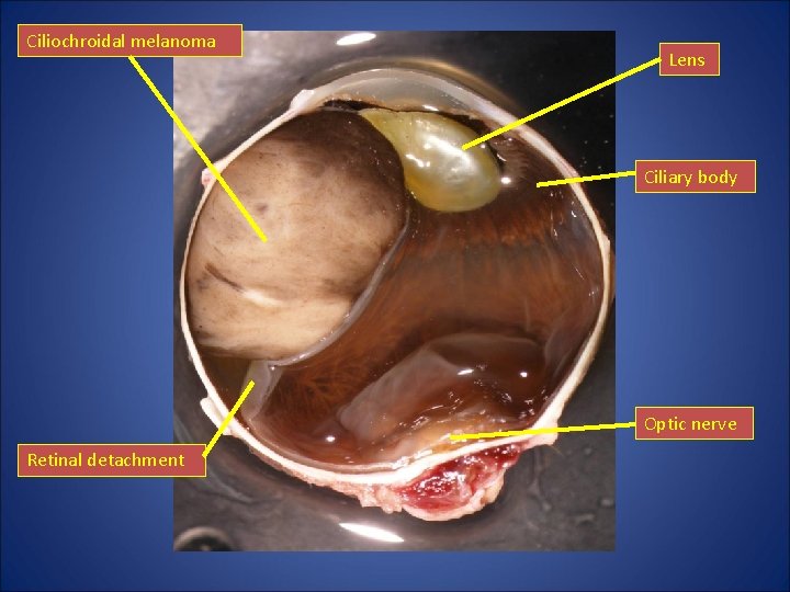 Ciliochroidal melanoma Lens Ciliary body Optic nerve Retinal detachment Ciliochroidal melanoma Lens Ciliary body Optic nerve Retinal detachment
