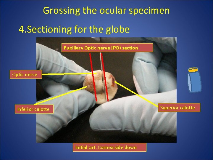 Grossing the ocular specimen 4. Sectioning for the globe Pupillary Optic nerve (PO) section Grossing the ocular specimen 4. Sectioning for the globe Pupillary Optic nerve (PO) section