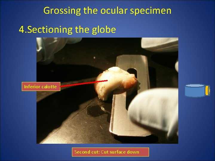 Grossing the ocular specimen 4. Sectioning the globe Inferior calotte Second cut: Cut surface Grossing the ocular specimen 4. Sectioning the globe Inferior calotte Second cut: Cut surface