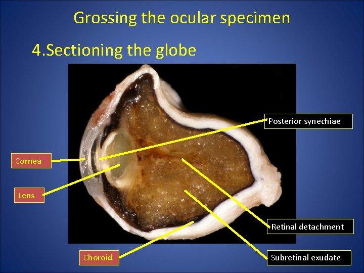 Grossing the ocular specimen 4. Sectioning the globe Posterior synechiae Cornea Lens Retinal detachment Grossing the ocular specimen 4. Sectioning the globe Posterior synechiae Cornea Lens Retinal detachment