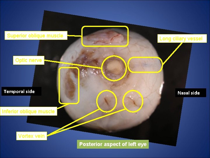 Superior oblique muscle Long ciliary vessel Optic nerve Temporal side Nasal side Inferior oblique Superior oblique muscle Long ciliary vessel Optic nerve Temporal side Nasal side Inferior oblique