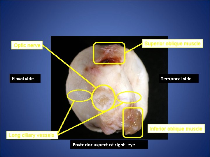 Superior oblique muscle Optic nerve Nasal side Temporal side Inferior oblique muscle Long ciliary Superior oblique muscle Optic nerve Nasal side Temporal side Inferior oblique muscle Long ciliary
