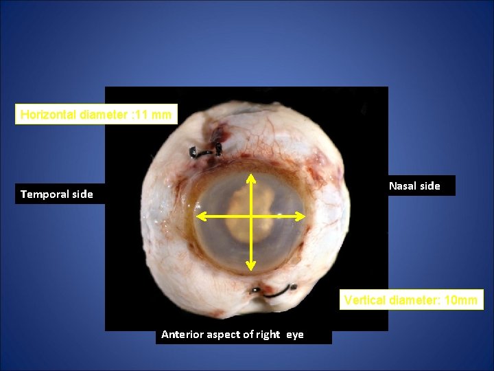 Horizontal diameter : 11 mm Nasal side Temporal side Vertical diameter: 10 mm Anterior Horizontal diameter : 11 mm Nasal side Temporal side Vertical diameter: 10 mm Anterior
