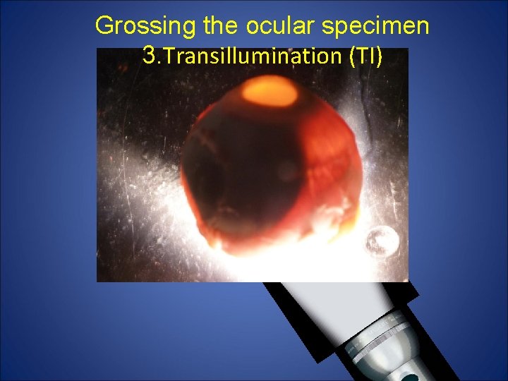 Grossing the ocular specimen 3. Transillumination (TI) Grossing the ocular specimen 3. Transillumination (TI)