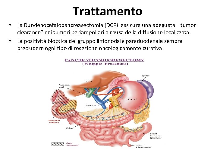 Trattamento • La Duodenocefalopancreasectomia (DCP) assicura una adeguata “tumor clearance” nei tumori periampollari a Trattamento • La Duodenocefalopancreasectomia (DCP) assicura una adeguata “tumor clearance” nei tumori periampollari a