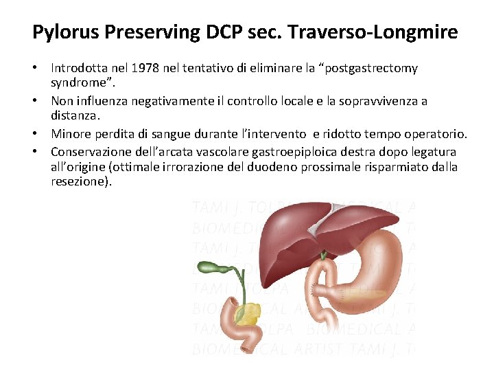 Pylorus Preserving DCP sec. Traverso-Longmire • Introdotta nel 1978 nel tentativo di eliminare la Pylorus Preserving DCP sec. Traverso-Longmire • Introdotta nel 1978 nel tentativo di eliminare la