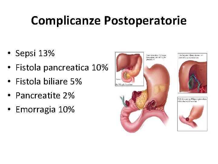 Complicanze Postoperatorie • • • Sepsi 13% Fistola pancreatica 10% Fistola biliare 5% Pancreatite Complicanze Postoperatorie • • • Sepsi 13% Fistola pancreatica 10% Fistola biliare 5% Pancreatite