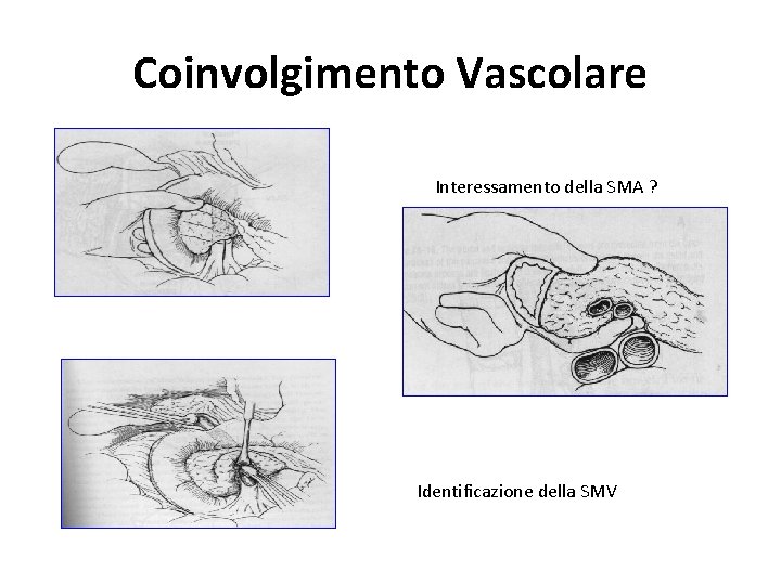 Coinvolgimento Vascolare Interessamento della SMA ? Identificazione della SMV Coinvolgimento Vascolare Interessamento della SMA ? Identificazione della SMV