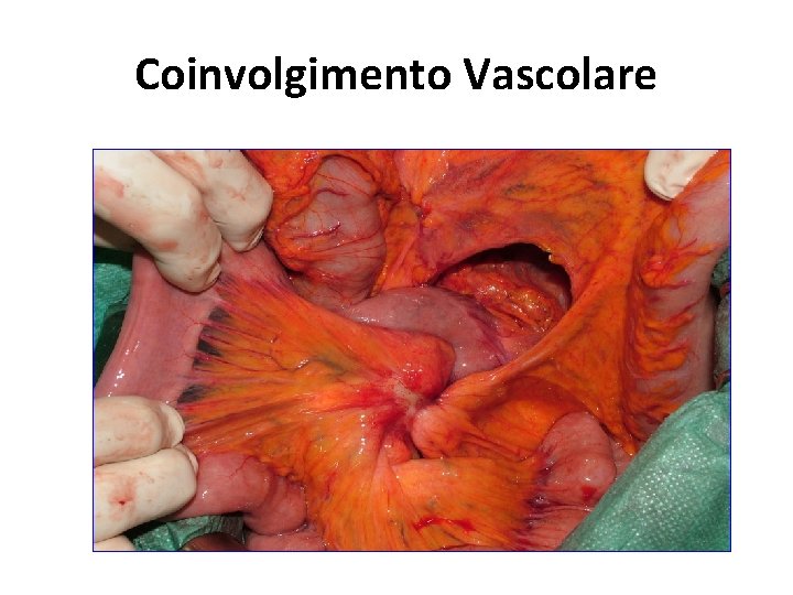 Coinvolgimento Vascolare Coinvolgimento Vascolare