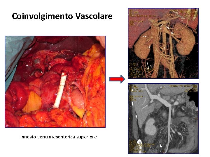 Coinvolgimento Vascolare Innesto vena mesenterica superiore Coinvolgimento Vascolare Innesto vena mesenterica superiore