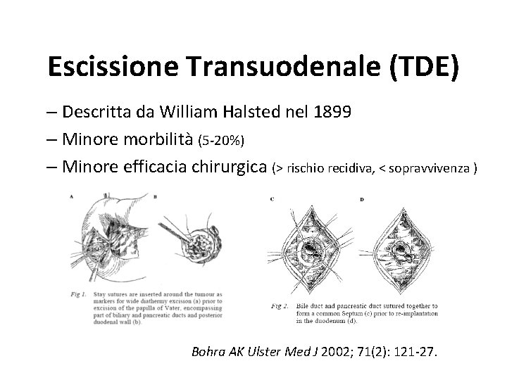 Escissione Transuodenale (TDE) – Descritta da William Halsted nel 1899 – Minore morbilità (5 Escissione Transuodenale (TDE) – Descritta da William Halsted nel 1899 – Minore morbilità (5