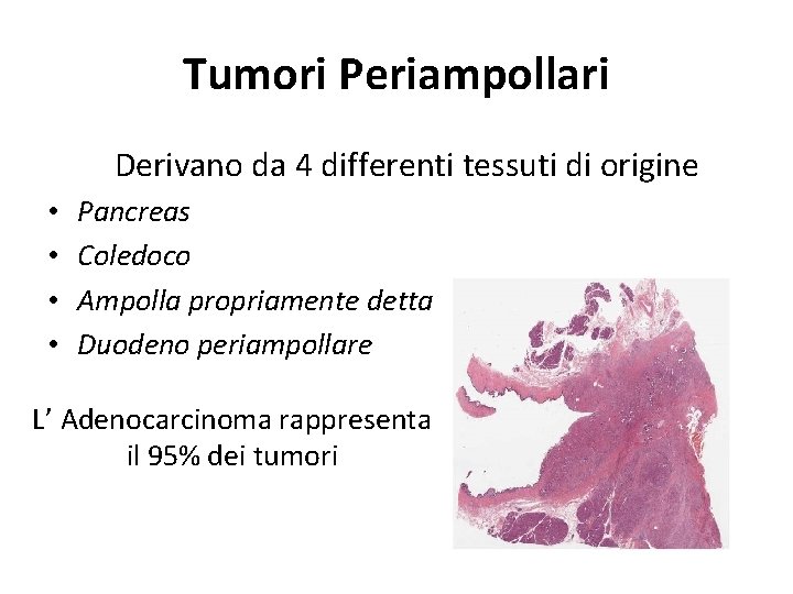 Tumori Periampollari Derivano da 4 differenti tessuti di origine • • Pancreas Coledoco Ampolla Tumori Periampollari Derivano da 4 differenti tessuti di origine • • Pancreas Coledoco Ampolla