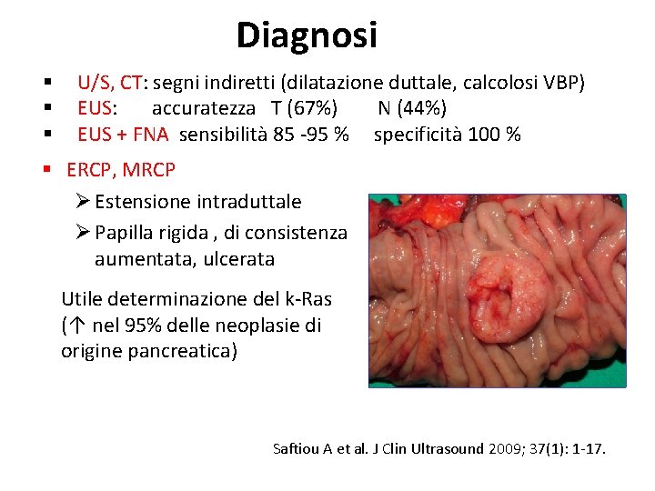 Diagnosi § § § U/S, CT: segni indiretti (dilatazione duttale, calcolosi VBP) EUS: accuratezza Diagnosi § § § U/S, CT: segni indiretti (dilatazione duttale, calcolosi VBP) EUS: accuratezza