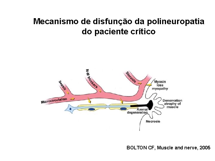 Mecanismo de disfunção da polineuropatia do paciente crítico BOLTON CF, Muscle and nerve, 2005