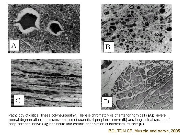 A C B D Pathology of critical illness polyneuropathy. There is chromatolysis of anterior