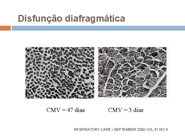 Disfunção diafragmática CMV = 47 dias CMV = 3 dias RESPIRATORY CARE • SEPTEMBER