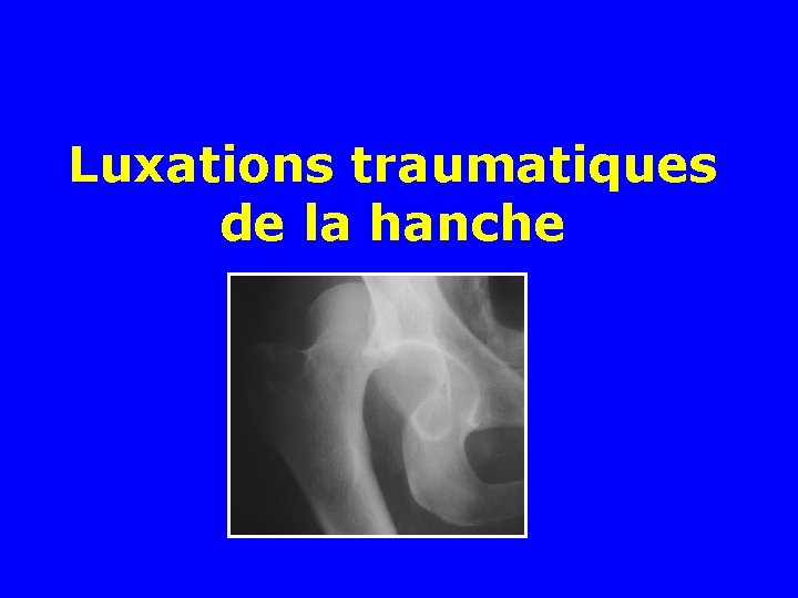 Luxations traumatiques de la hanche 