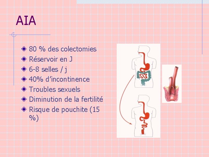 AIA 80 % des colectomies Réservoir en J 6 -8 selles / j 40%