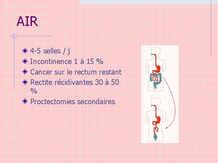 AIR 4 -5 selles / j Incontinence 1 à 15 % Cancer sur le