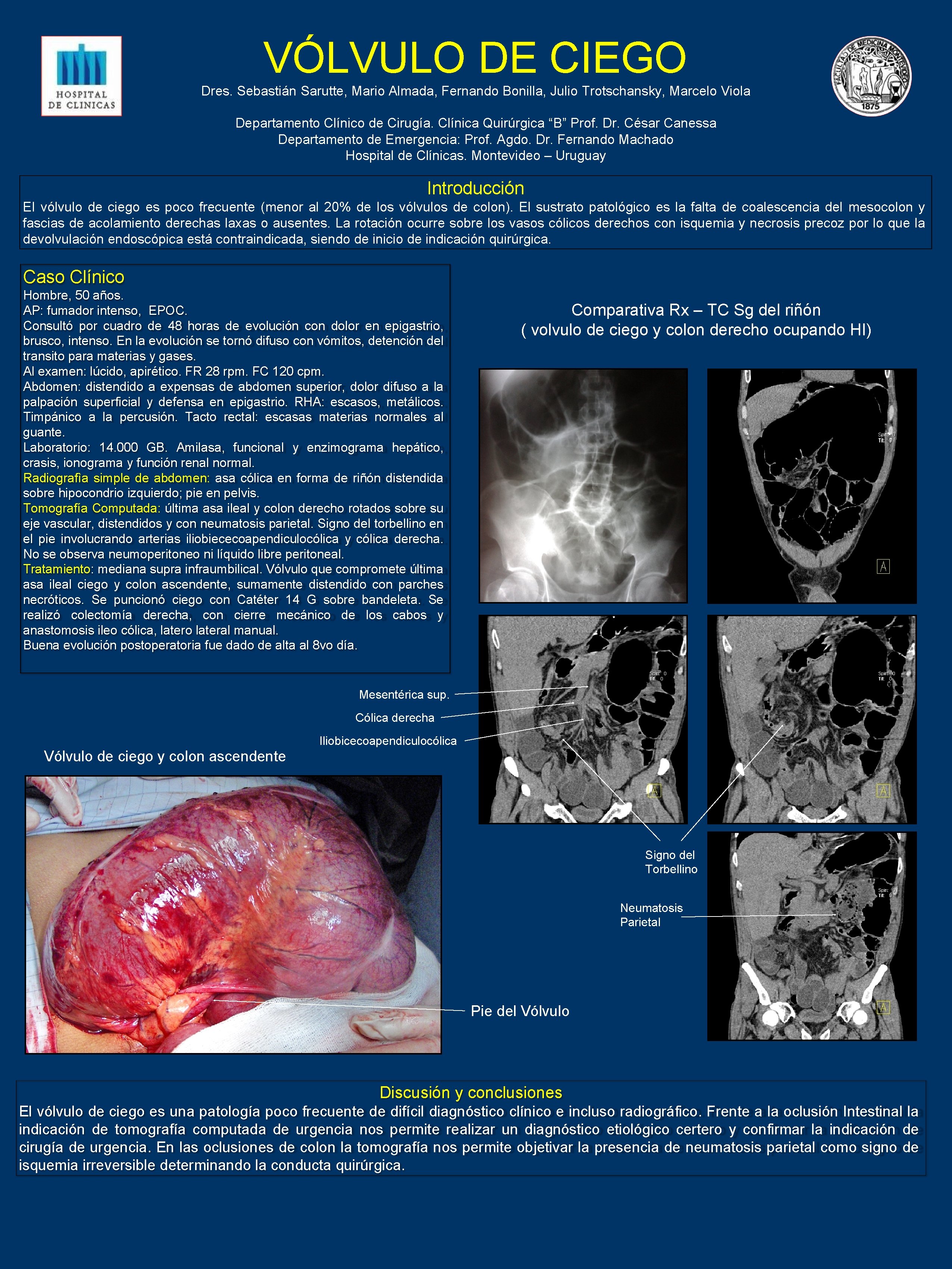 VÓLVULO DE CIEGO Dres. Sebastián Sarutte, Mario Almada, Fernando Bonilla, Julio Trotschansky, Marcelo Viola