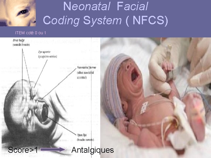 Neonatal Facial Coding System ( NFCS) ITEM coté 0 ou 1 Score>1 Antalgiques 