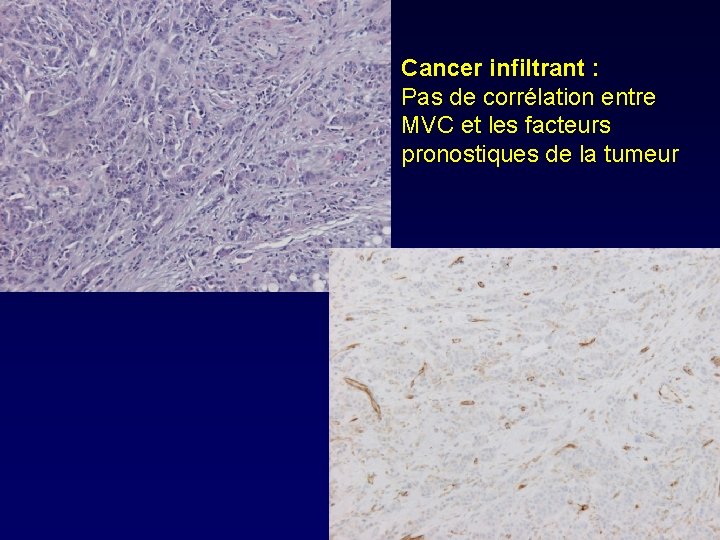 Cancer infiltrant : Pas de corrélation entre MVC et les facteurs pronostiques de la