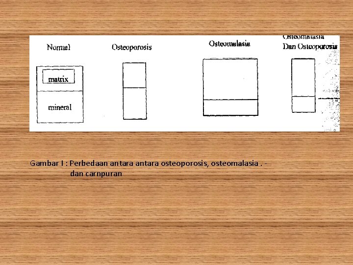 Gambar I : Perbedaan antara osteoporosis, osteomalasia. dan carnpuran 