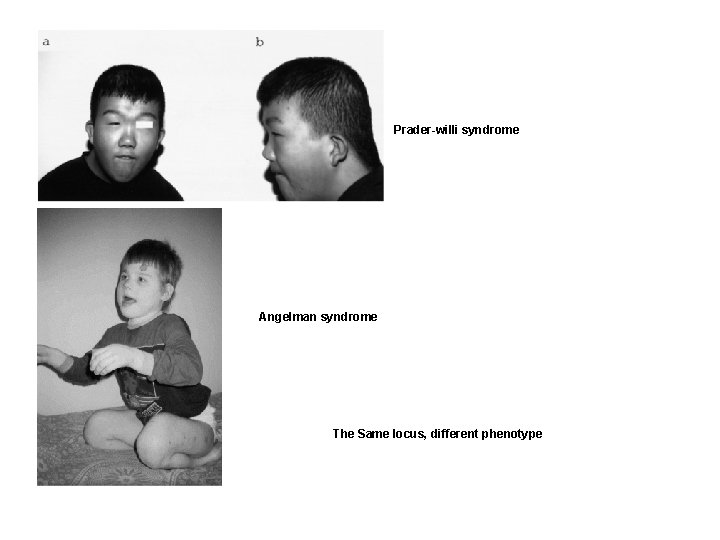 Prader-willi syndrome Angelman syndrome The Same locus, different phenotype 