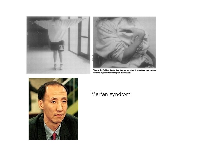 Marfan syndrom 