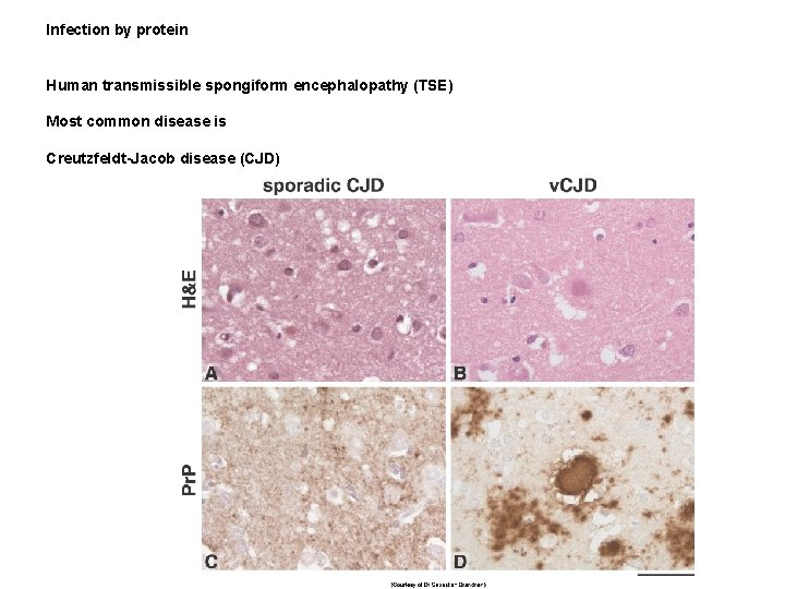 Infection by protein Human transmissible spongiform encephalopathy (TSE) Most common disease is Creutzfeldt-Jacob disease