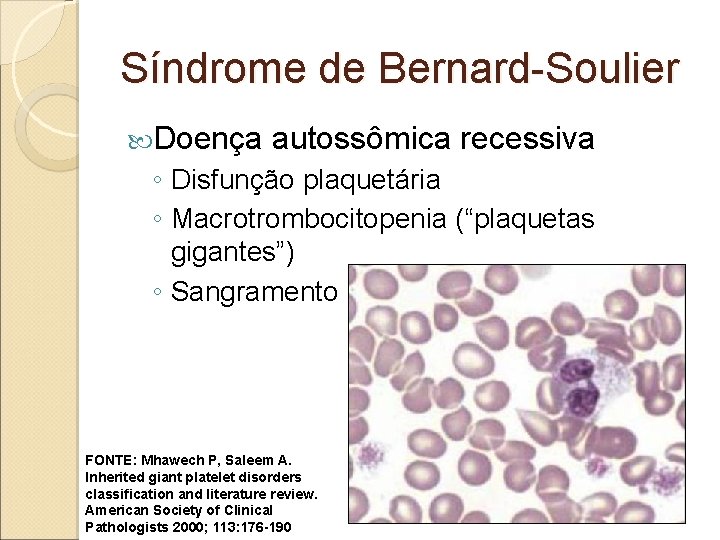 Síndrome de Bernard-Soulier Doença autossômica recessiva ◦ Disfunção plaquetária ◦ Macrotrombocitopenia (“plaquetas gigantes”) ◦