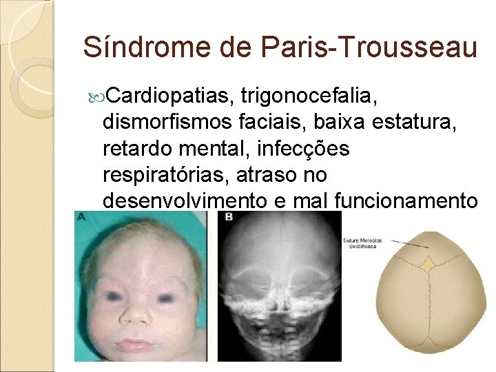 Síndrome de Paris-Trousseau Cardiopatias, trigonocefalia, dismorfismos faciais, baixa estatura, retardo mental, infecções respiratórias, atraso