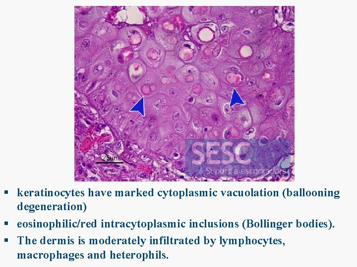 § keratinocytes have marked cytoplasmic vacuolation (ballooning degeneration) § eosinophilic/red intracytoplasmic inclusions (Bollinger bodies).