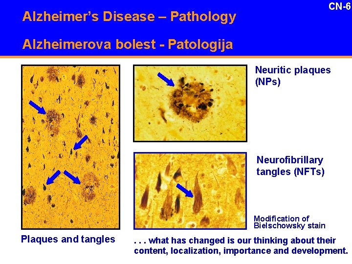 CN-6 Alzheimer’s Disease – Pathology Alzheimerova bolest - Patologija Neuritic plaques (NPs) Neurofibrillary tangles